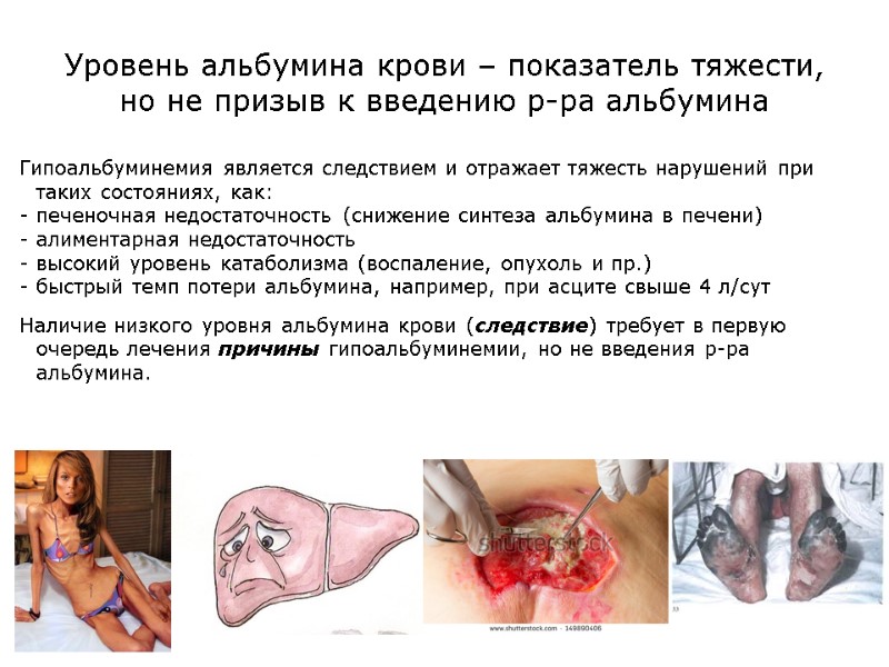 Уровень альбумина крови – показатель тяжести, но не призыв к введению р-ра альбумина Гипоальбуминемия